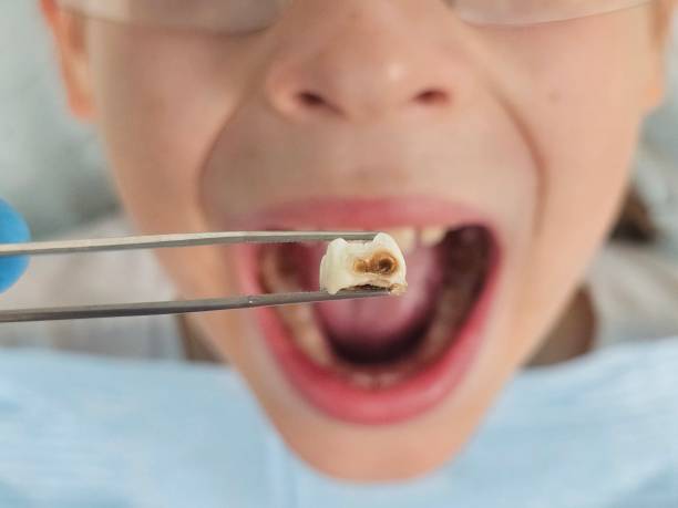 Best Teeth Whitening  in Lexico, CA